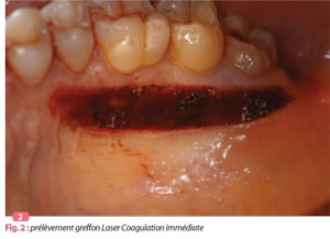 prelevement-greffon-laser-coagulation-immediate
