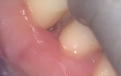 Technique d’assainissement parodontal microchirurgical assisté au LASER Er-Yag