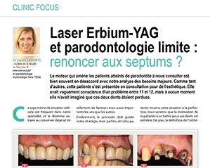 Laser erbium-Yag et parodontologie limite : renoncer aux septums ?