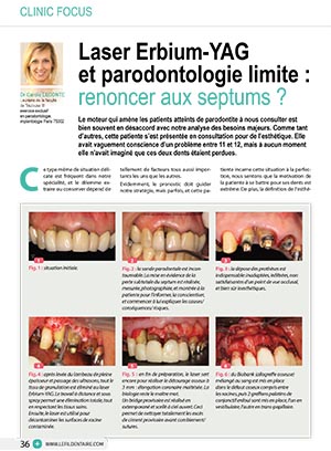 laser-erbium-yag-et-parodontologie-limite-renoncer-aux-septums-1