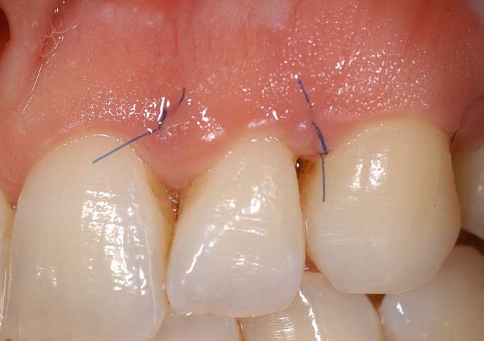 Exploitation des effets photo-ablatifs et photo-acoustique du LASER Er-Yag pour une une chirurgie parodontale d’assainissement mini-invasive. Résultats à 3 jours post-opératoires.