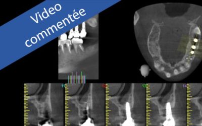 Péri-implantite : Traitement chirurgical assisté au LASER Er-Yag